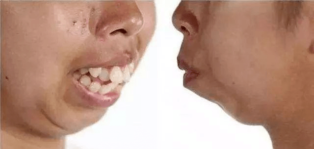 牙颌面畸形人的脸型图片