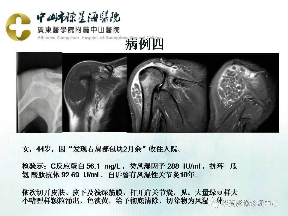 米粒体滑膜炎影像表现