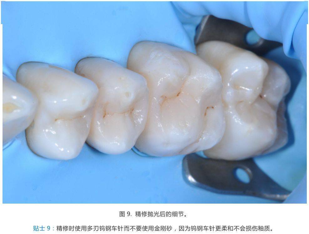 10个后牙直接充填注意点