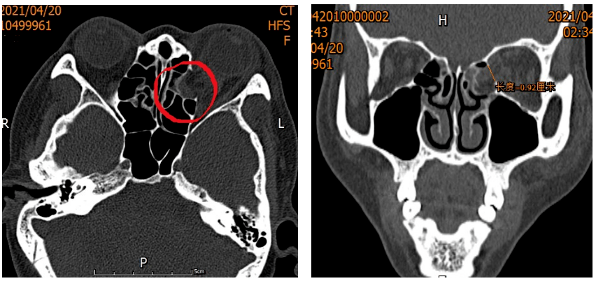 ct终于发现了问题所在—原来是外伤导致李孃孃左侧眼眶内侧壁部分