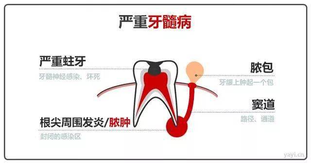 牙龈发炎流脓怎么办