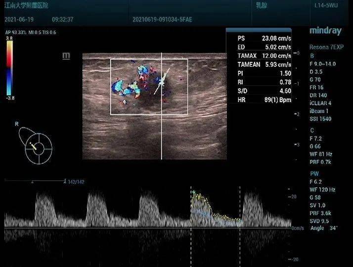 图 2 cdfi 见较丰富血流信号图 1 右侧乳腺 10 点钟方向见一低回声