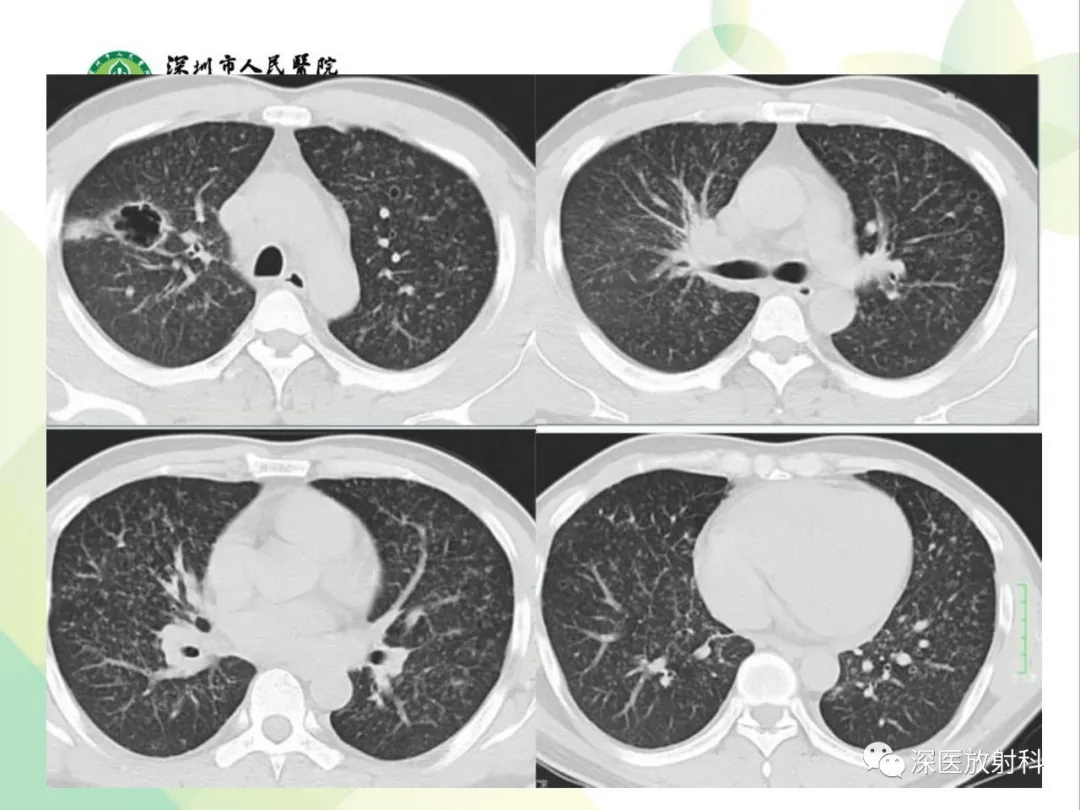 肺弥漫性磨玻璃密度病变的ct诊断