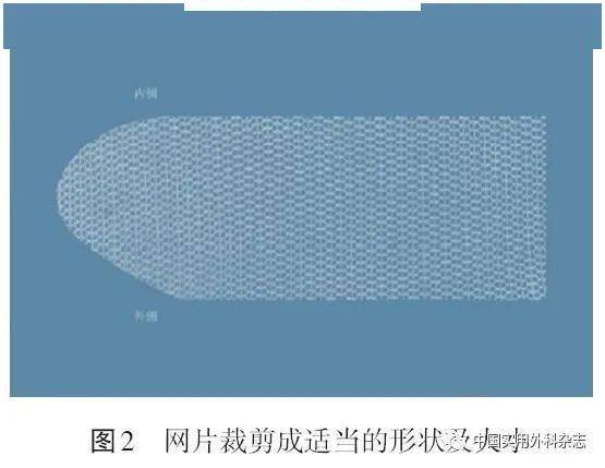 指南与共识lichtenstein手术规范化操作中国专家共识2021
