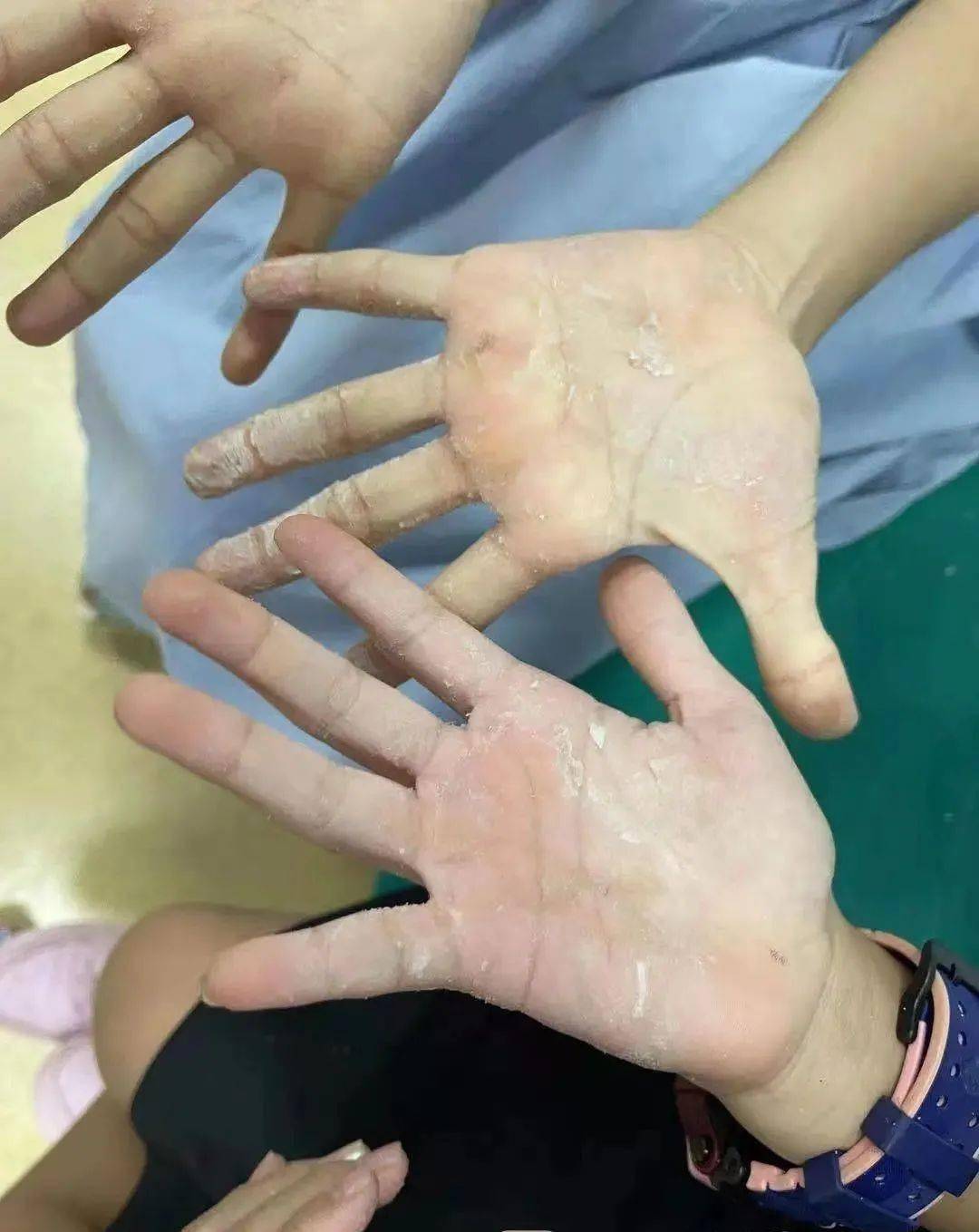 遭到他人恶作剧南宁两个小女孩手掌被502胶水粘住分不开