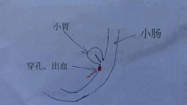 肿块|太稀奇了！18岁男子腹痛难忍，一查发现肠子里竟然长了个…