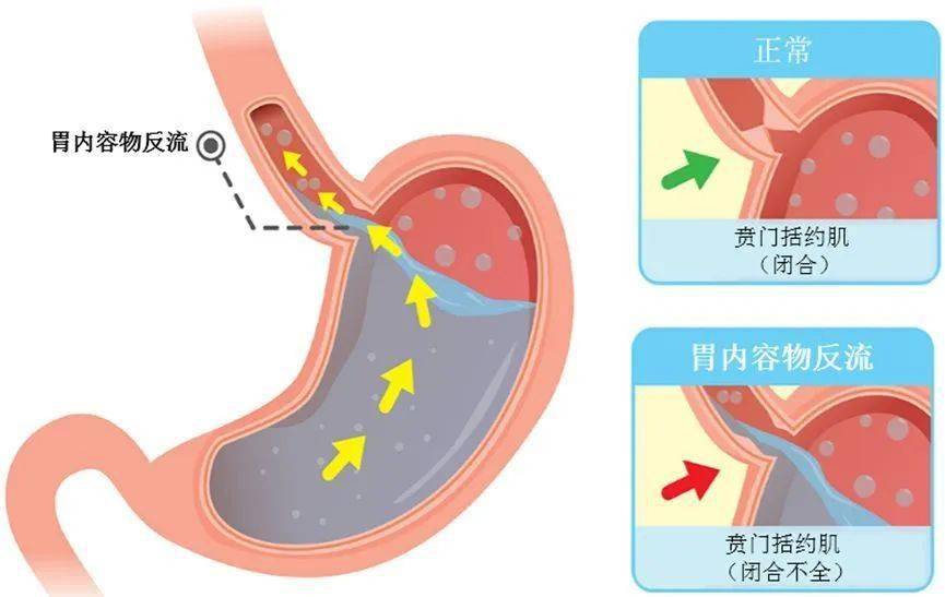 大咖坐診丨得了胃食管反流病怎麼辦消化內科專家為您全面解析