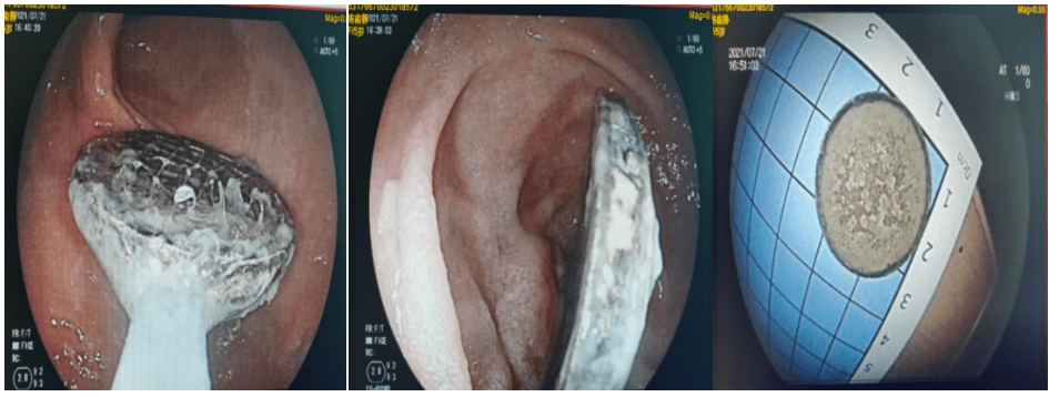 开腹|熊孩误吞硬币1年，还不在胃里？深圳这家医院“探囊取物”