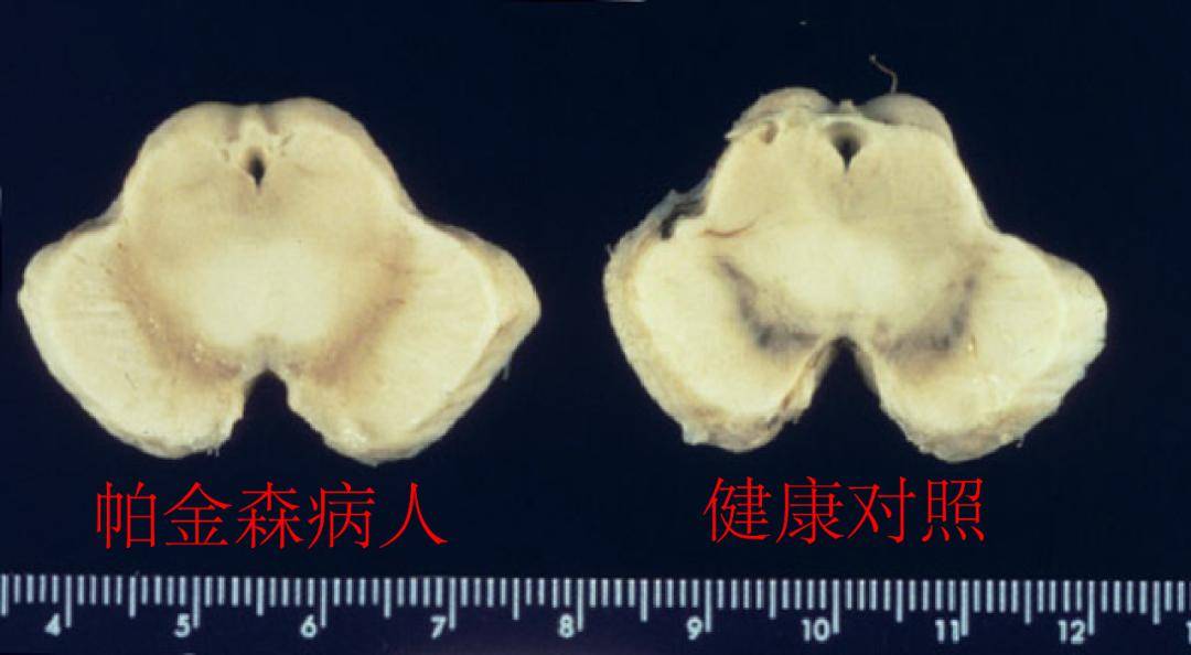 镇静剂|治疗帕金森：大脑深处，一颗核桃大小的谜团