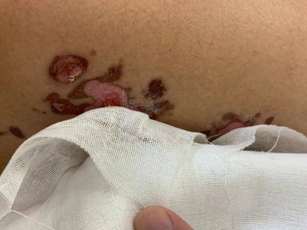 干冰|男子扭伤后用它冷敷，皮肤严重冻伤发紫！很多人都不知道...