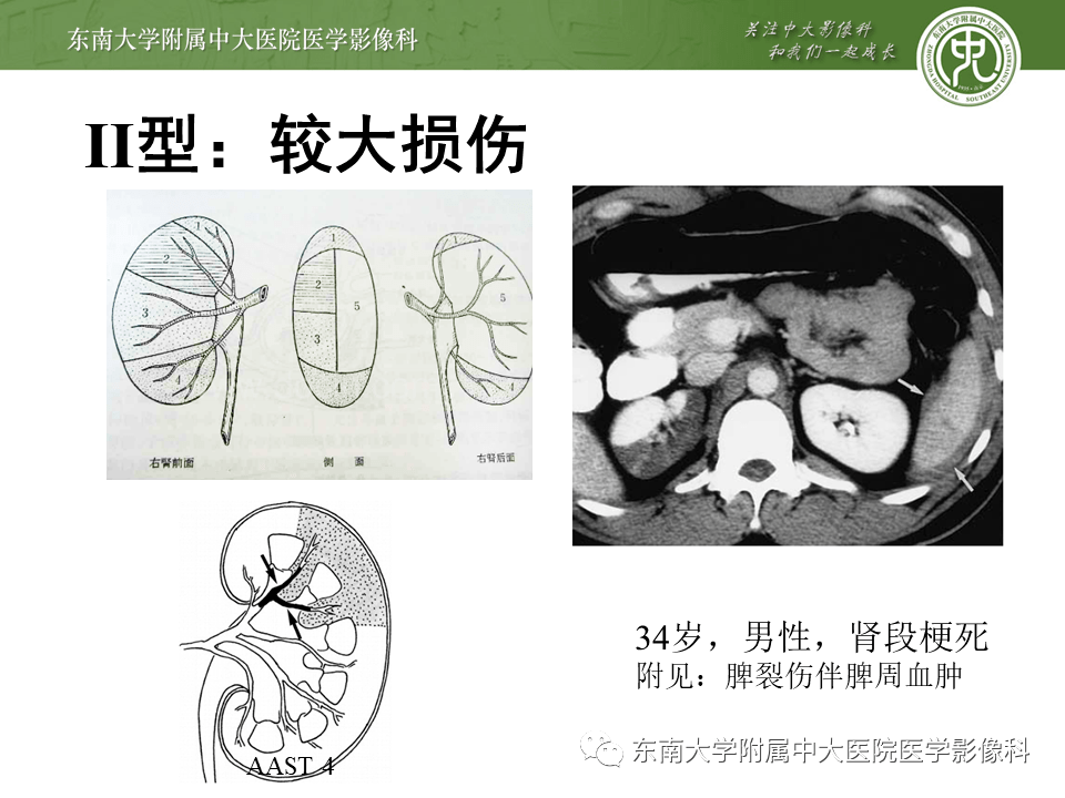 腎臟外傷影像學評估_解剖圖