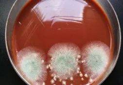 抵抗力|肺发霉？！杭州女子反复咳嗽10多年，医生从肺里“挖”出“臭鸡蛋”