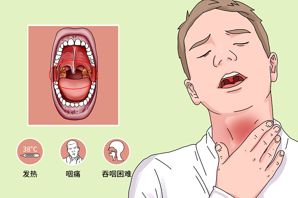 扁桃体周围脓肿如未及时控制,脓肿可破坏周围组织至咽旁间隙,形成咽旁