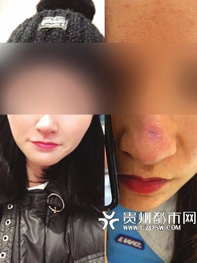 妙龄|妙龄女鼻子留下一道疤