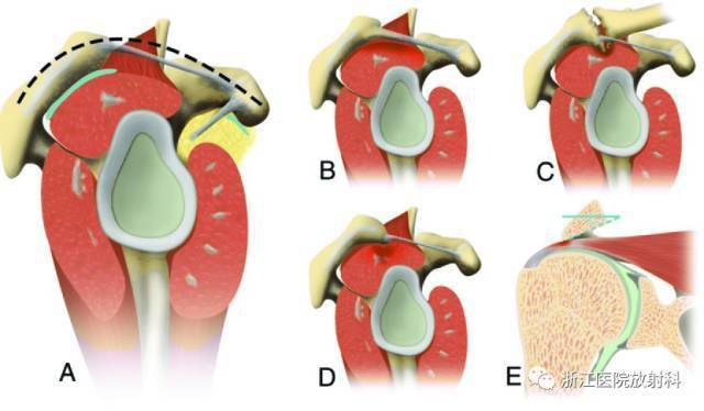 a图虚线为喙肩弓.