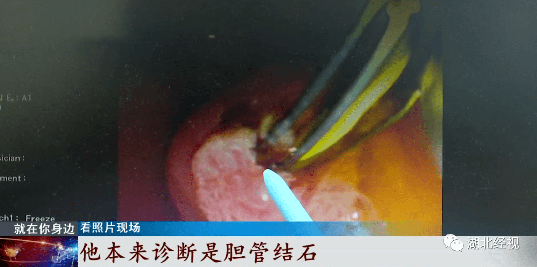 男子|男子体内出现大量活寄生虫！和这种饮食习惯有关