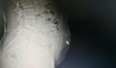 针灸|惊险！广州阿婆自行针灸，针断腹中！医生：擅自针灸有风险