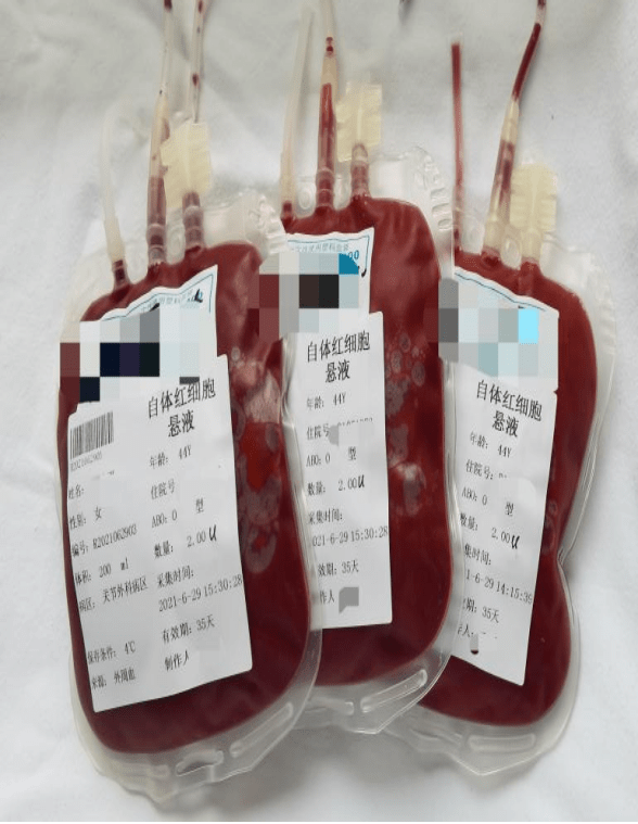 担心手术用血不够深度自体采血技术助大手术顺利开展