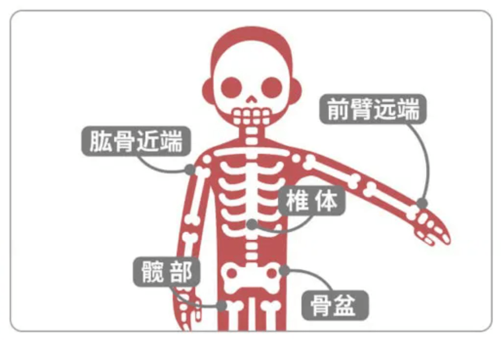 大二男生掰手腕手臂骨折年纪轻轻骨头怎么就酥脆了
