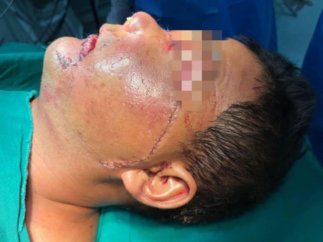 面部|警示丨宁夏男子骑摩托翻车，面部严重毁损，下唇几乎脱落！