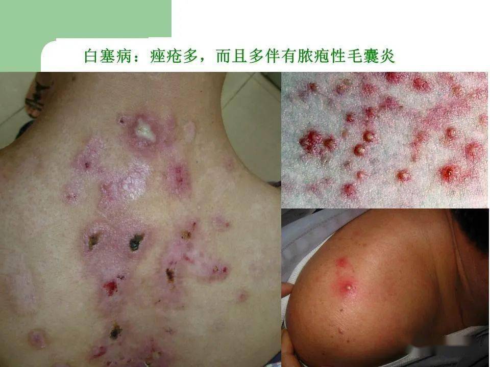 警惕白塞病临床各学科常见的20个陷阱