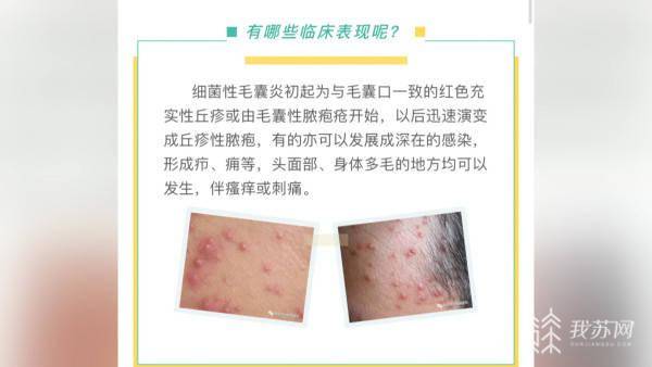 建议|高温下穿防护服、戴口罩 如何防止“闷”出皮肤病？