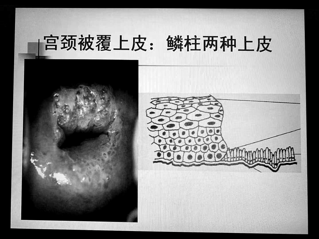 宫颈柱状上皮异位图片图片