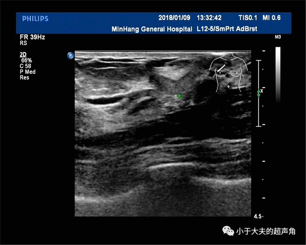 【附图】乳腺导管原位癌钼靶摄片及MRI表现_乳腺肿瘤学 | 天山医学院