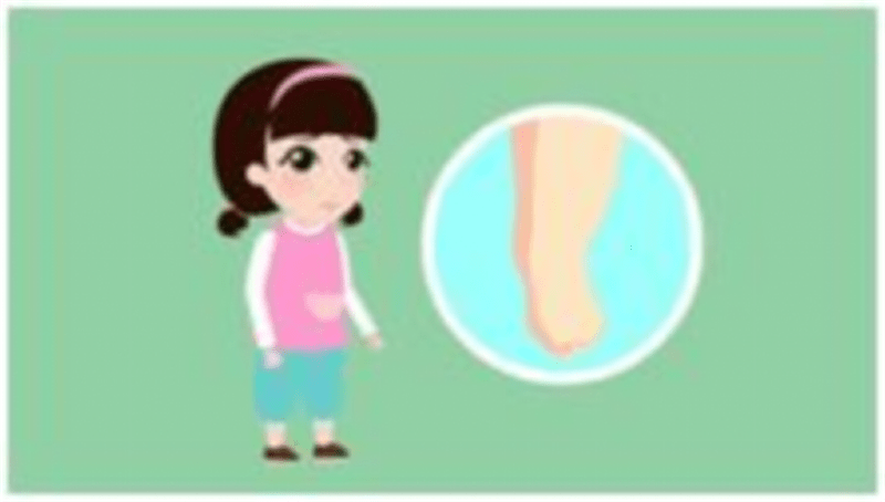 综合征|儿童双眼浮肿、小便量少莫大意,警惕“肾病综合征”