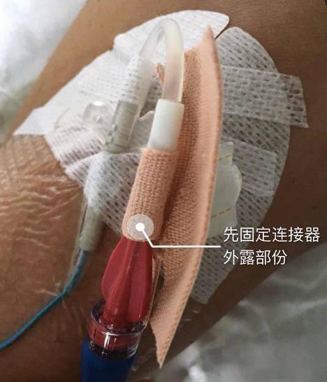 导管滑脱有原因这些小技巧赶紧收好