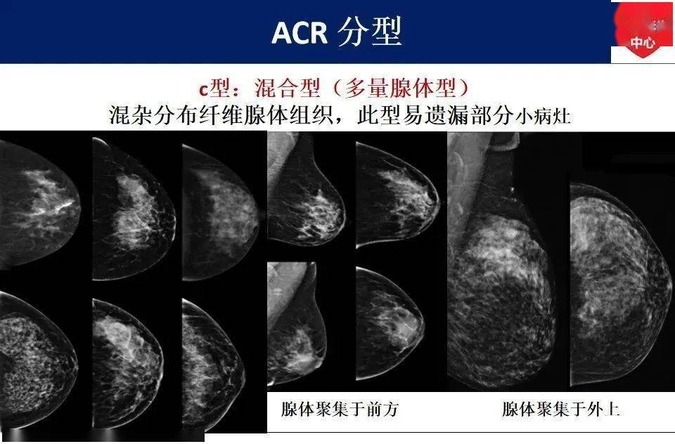 最新版乳腺x線birads分類解讀