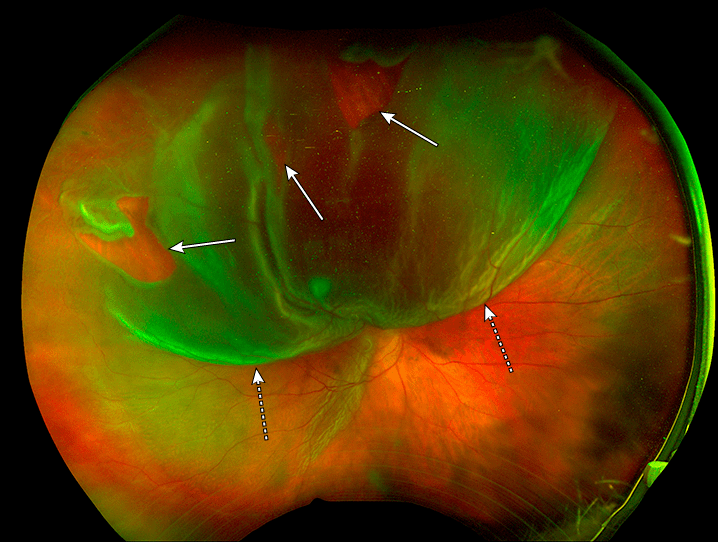 视网膜脱离眼底照相(实现箭头示视网膜裂孔,虚线箭头示脱离的视网膜