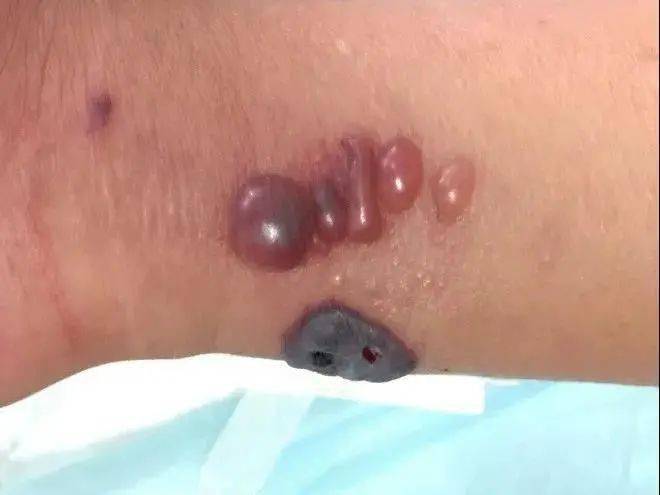 【朝阳疾控提醒您】炭疽是啥?你想知道的都在这里!