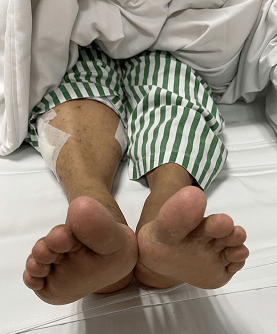 血栓|64岁阿姨体内取出长达一米的血栓！病因居然是心跳不规律？