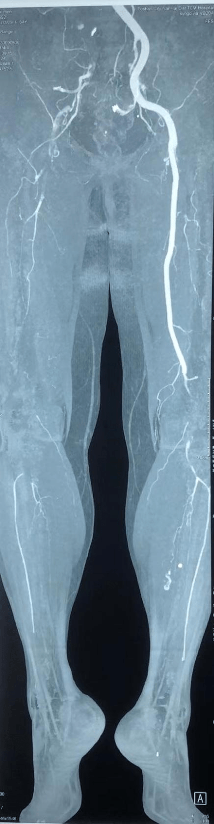 血栓|64岁阿姨体内取出长达一米的血栓！病因居然是心跳不规律？