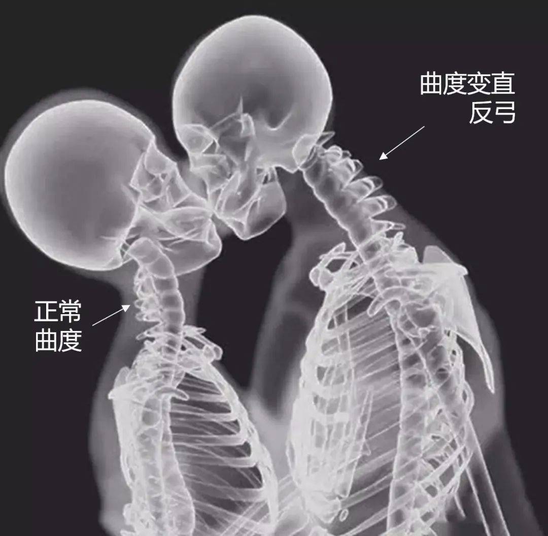 颈椎有正常生理曲度做上图动作时，最好保持颈中立位