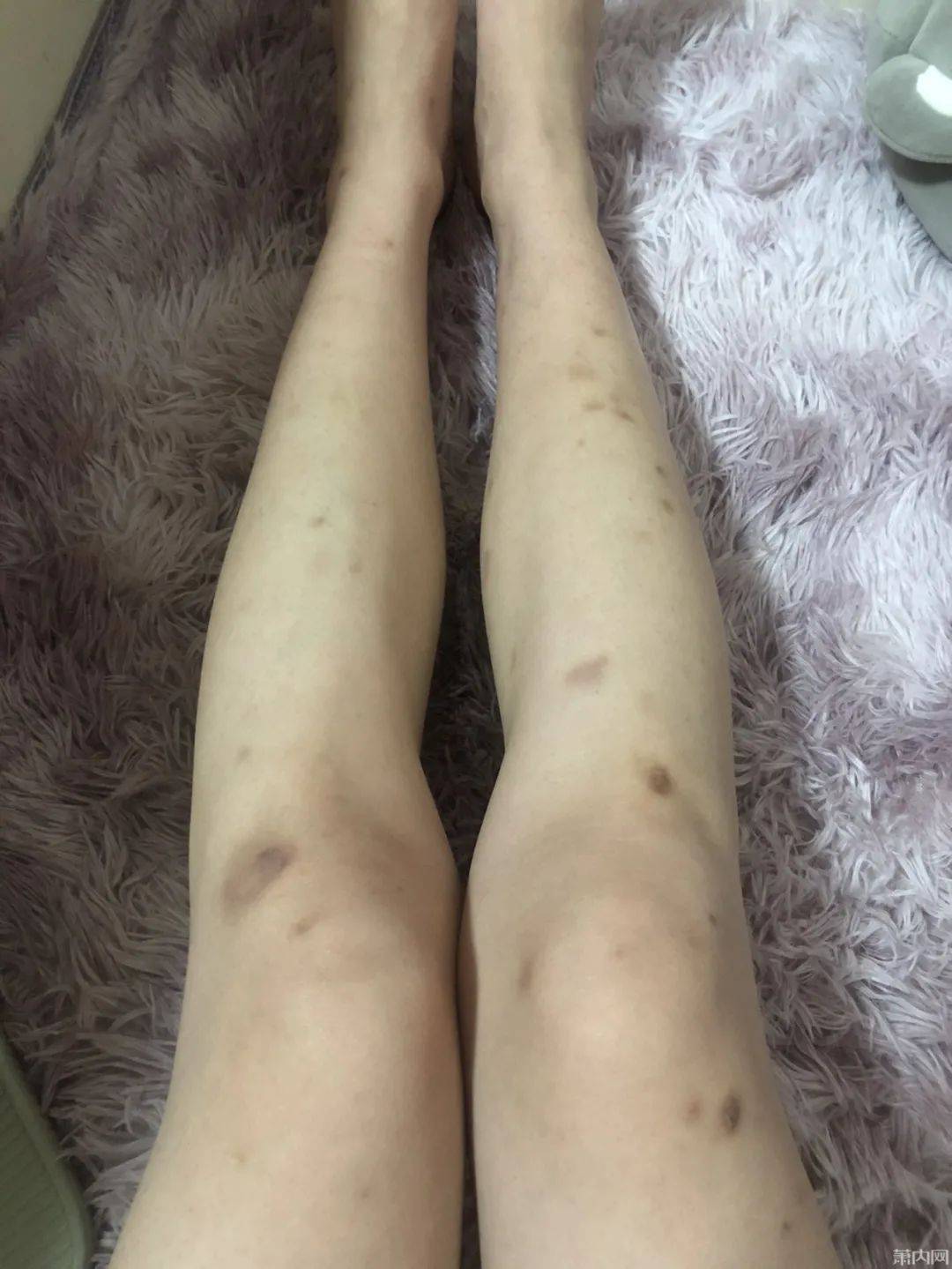 楼主|我的腿还有救吗？姑娘求助：每年一到夏天就变成这样