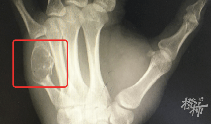 肿瘤|小伙七年“键盘手”不以为意，医生：你的骨头里融成“豆腐渣”了