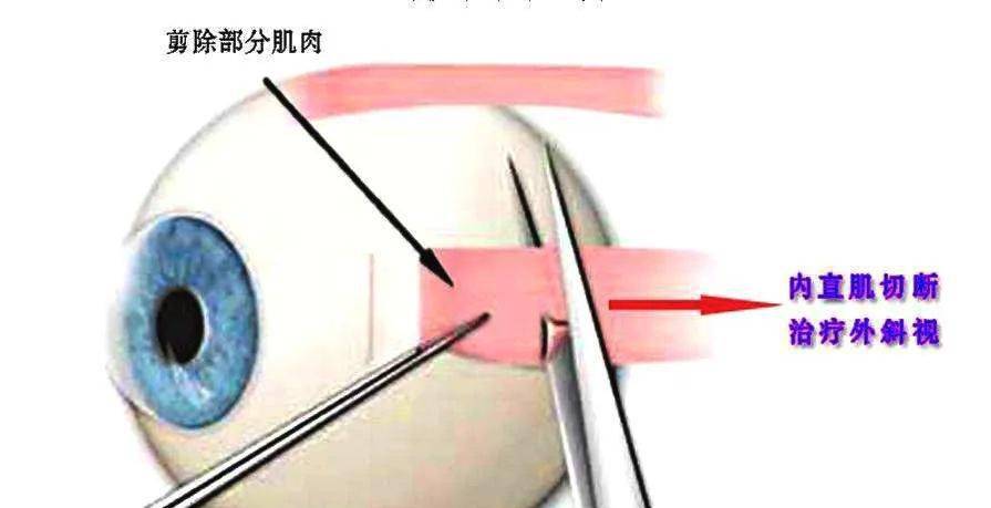 啥是内斜 c261c5874c7d4604b5d4328e53f33753.jpeg