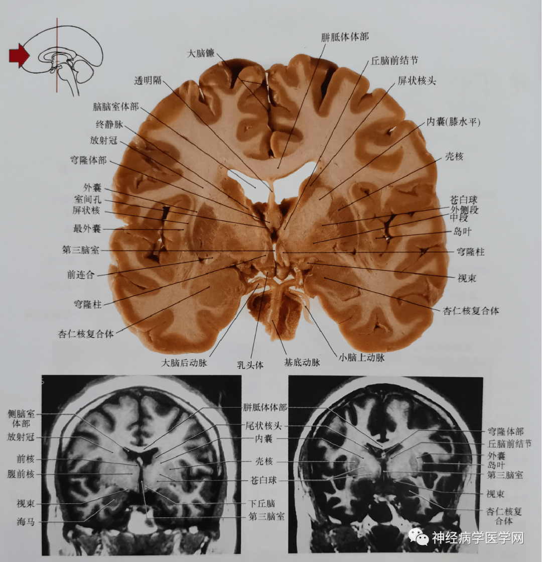 与图1相比,尾状核显示较小,苍白球比较明显,内侧邻近壳核.