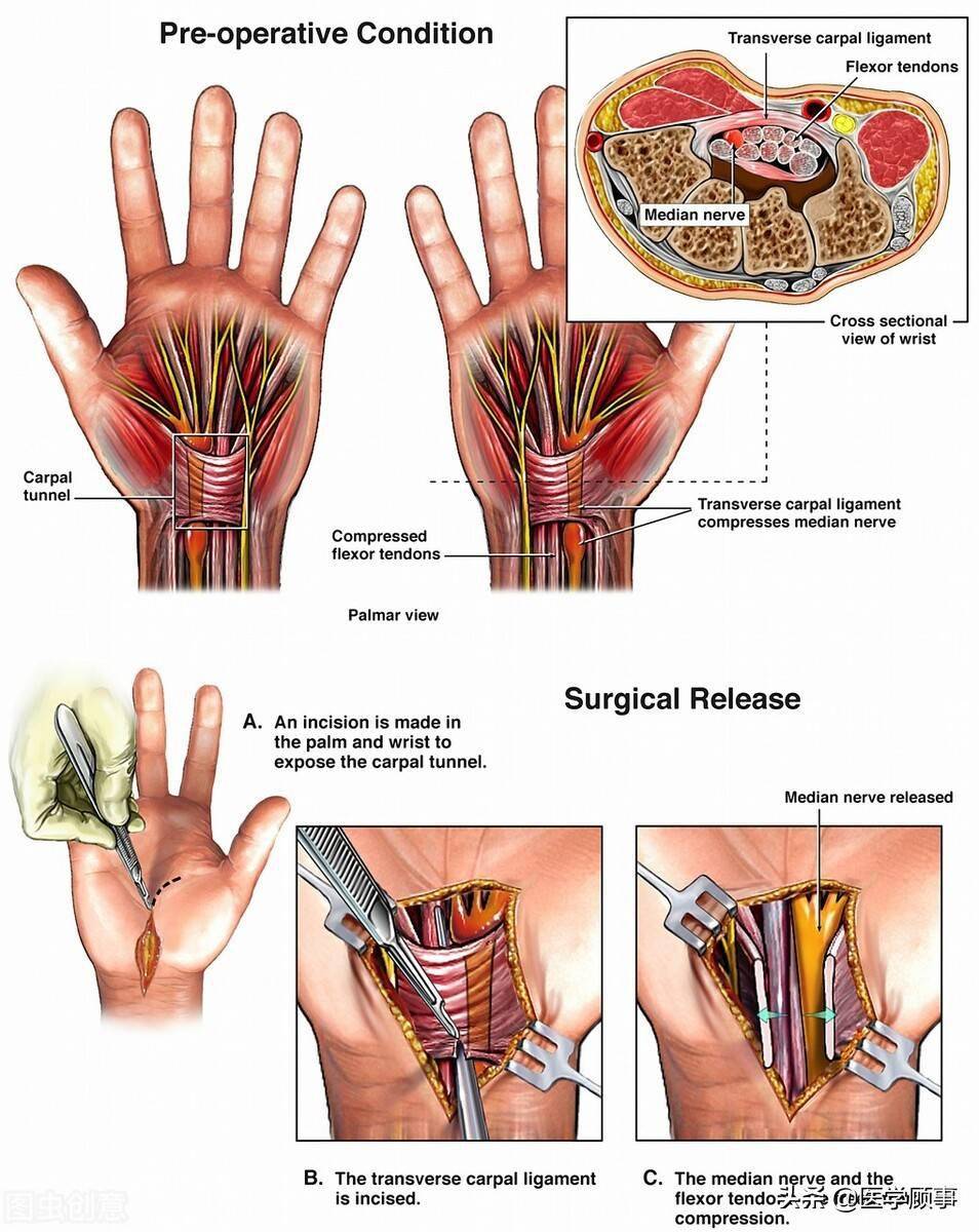 腕管综合症解剖图图片