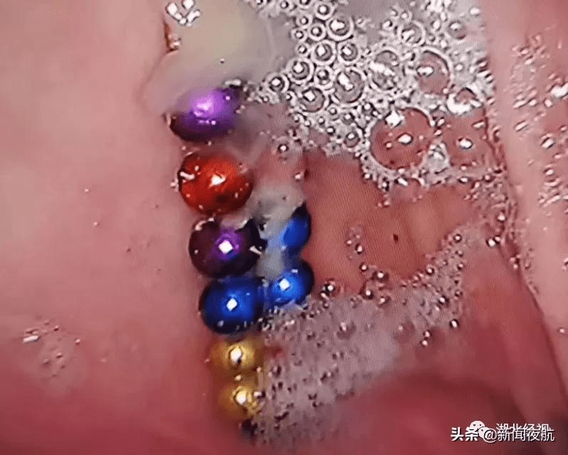 气道|又是它！4岁孩童以为是糖，一口气吞下26颗