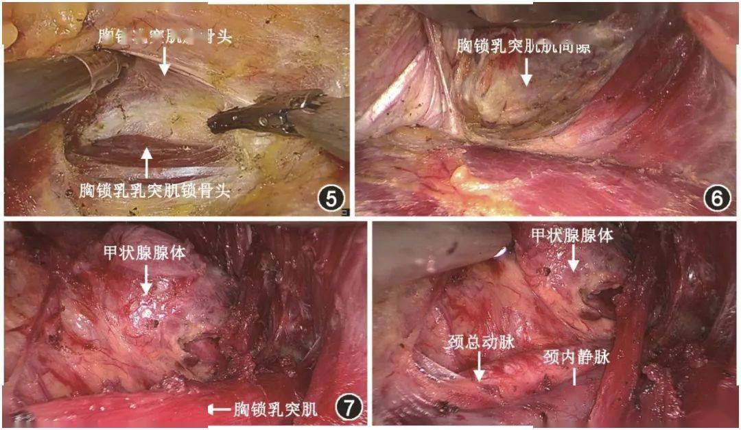 周雨秋無充氣經腋完全腔鏡下胸鎖乳突肌後緣與胸鎖乳突肌間隙入路治療