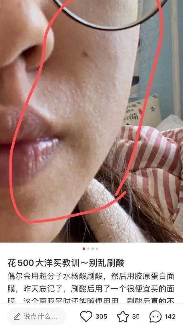 女大学生在宿舍自己刷酸被烧伤化学换肤变成烂脸