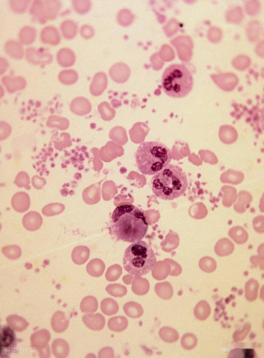 中性粒细胞铁死亡:系统性红斑狼疮致病新机制
