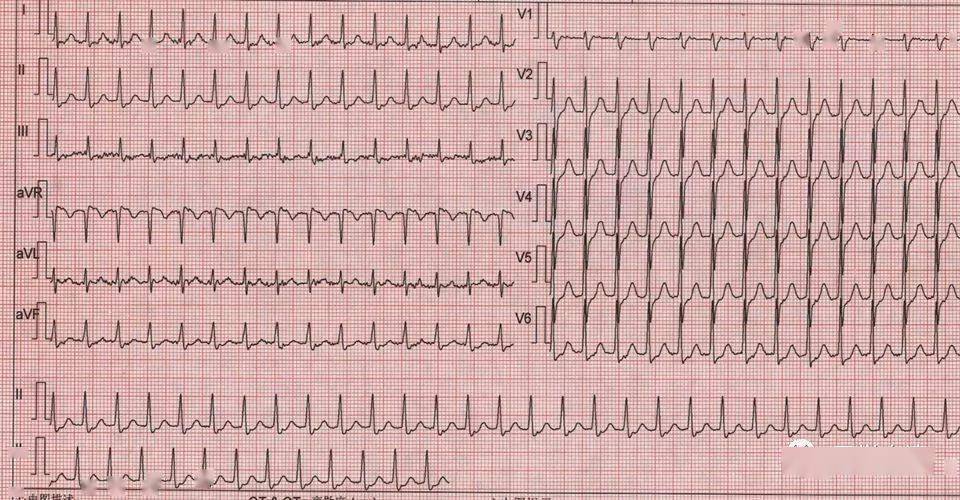 心电图总是记不住这些基础知识一定要掌握