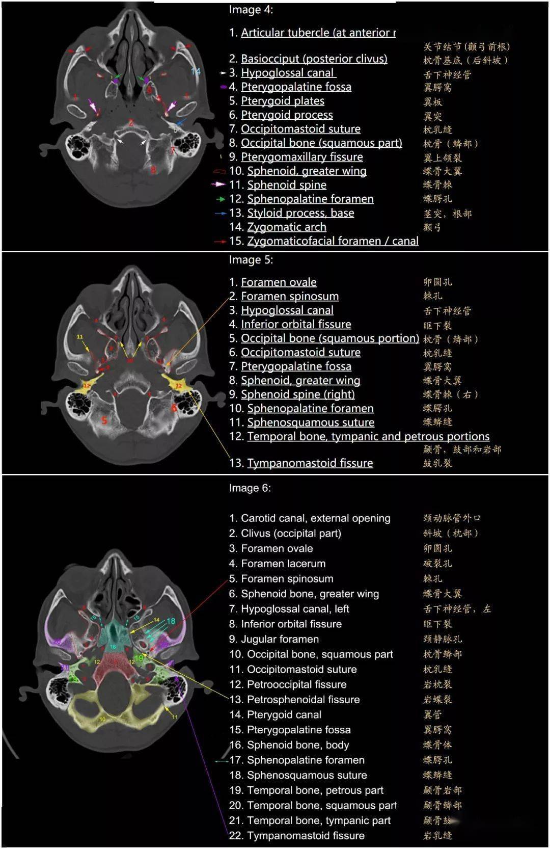 超详细颅底ct高清断层解剖图谱不能错过