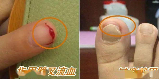 双立人|用了20多年才知道，指甲剪加上这个小机关，就能让指甲从此不再乱「飞」！