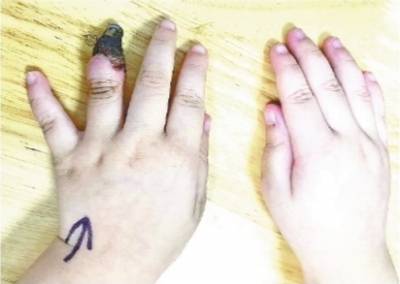 伤口|家长“环状包扎”致3岁女童“截指”