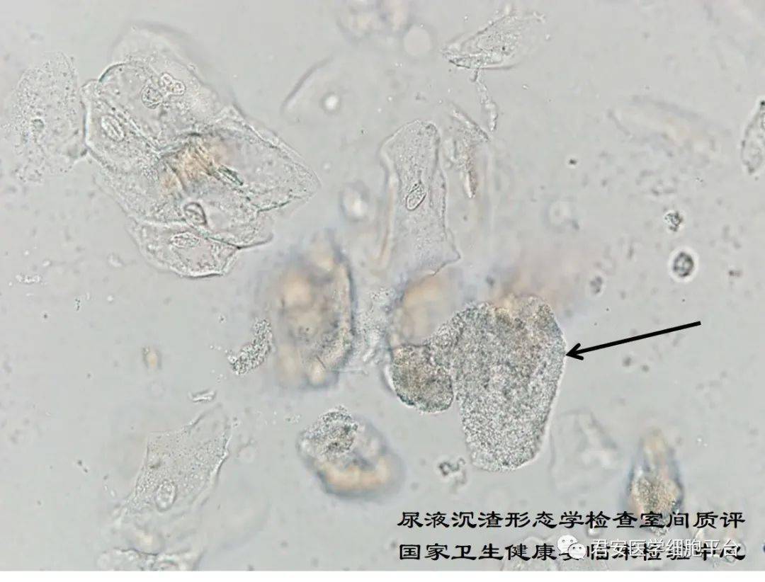 2021年尿液沉渣形态学检查室间质量评价